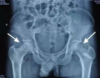 为什么有的人年纪轻轻,却患上股骨头坏死?